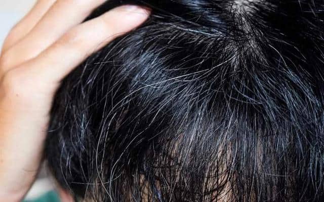 Early Greying of Hair: Why, How and What to Do? - The Indian Med